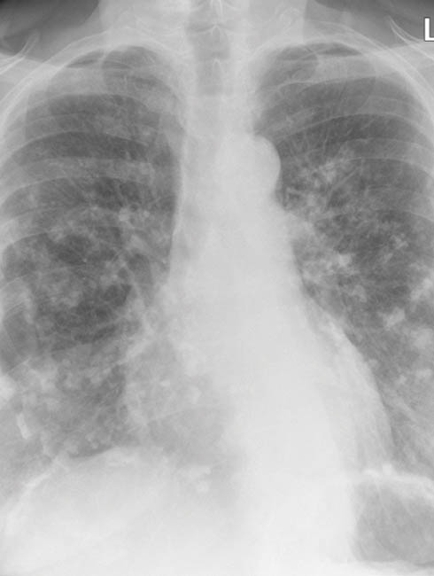 patho-14674376-asbestos-related-pleural-plaques-on-chest-xray-of-woman.jpg
